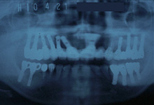 インプラント症例 レントゲン写真 治療後