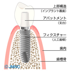 インプラント